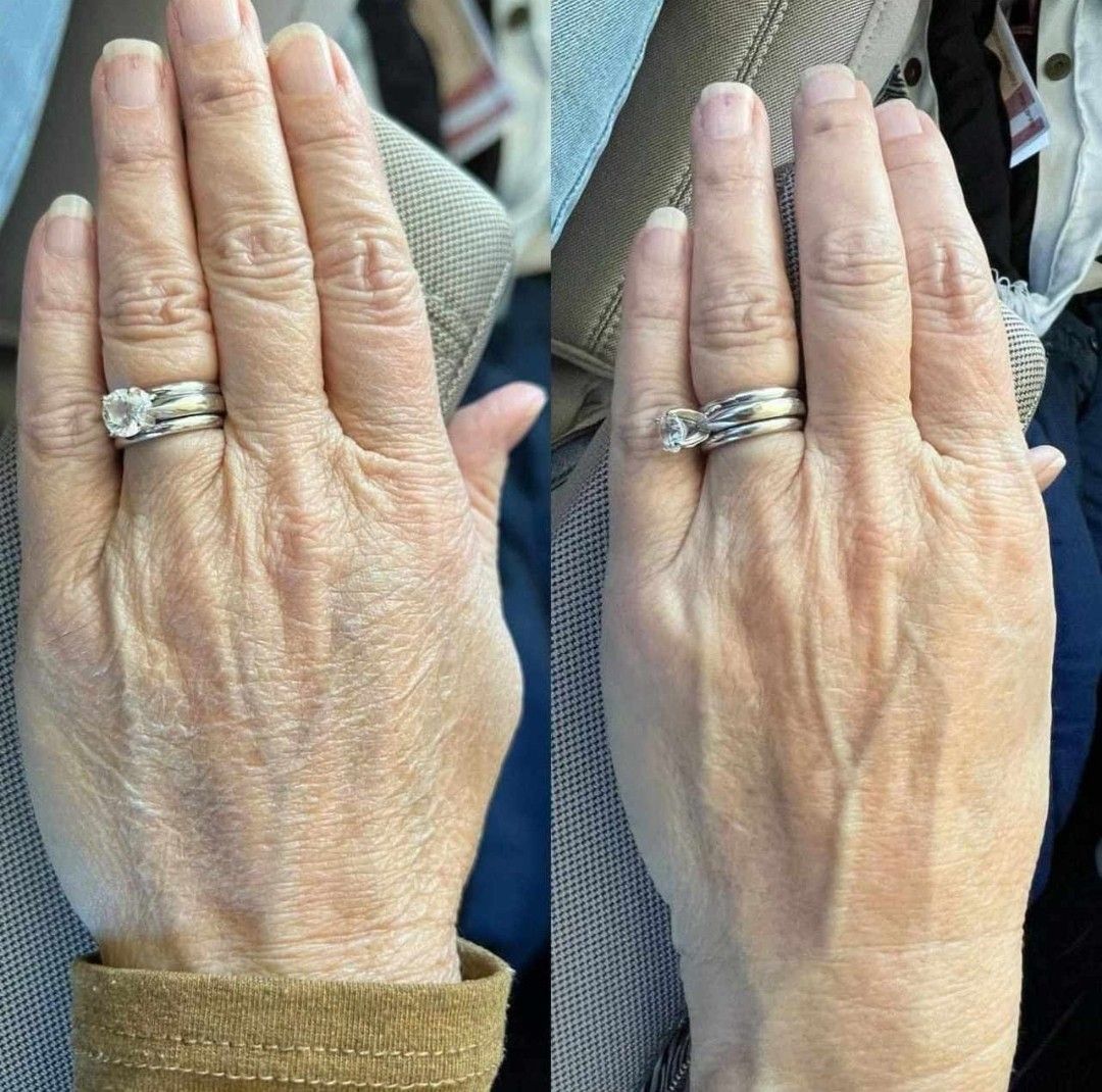 Before and after HandSolace results, Margaret, 68 · Adelaide