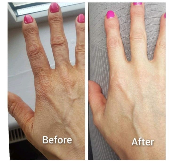 Before and after HandSolace results, Denise, 61 · Brisbane