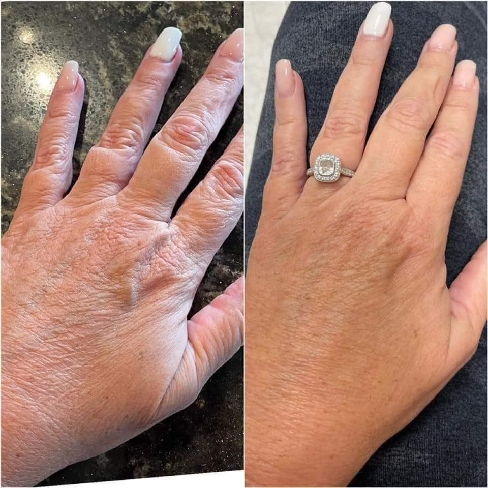 Before and after HandSolace results, Helen, 58 · Perth